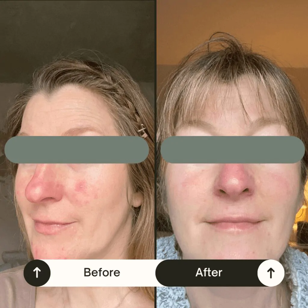 joel radley client testimonial review rosacea toxicity before and after london nutritionist functional